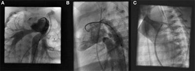 Popular Hybrid Congenital Heart Procedures without Cardiopulmonary Bypass